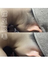 リリーブー 池袋(Lilyboo)/襟足脱毛