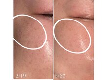 楚々(SOSO)/１回目からの肌変化が凄い！