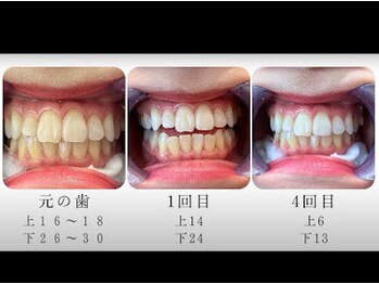 エクシアホワイトニング 倉敷店/美容ホワイトニング効果