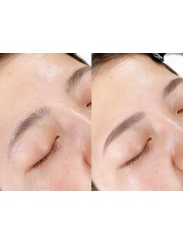 顔脱毛がしたい