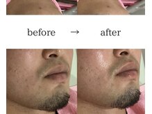 スパイリーア(Spiraea)/フェイシャルBeforeAfter