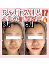 アルムダアクア 天王寺店(Aleumda AQUA)/ハーブピーリング/大阪/天王寺