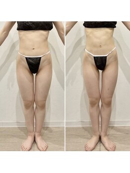 アンジュ(ange)/20代/脚がみるみる美脚に！