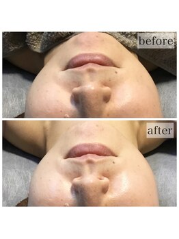 アウラ(AURA)/ダクトピール+光フェイシャル