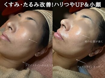 ミトラ(MITRA)/40代～の肌質改善☆リフトアップ