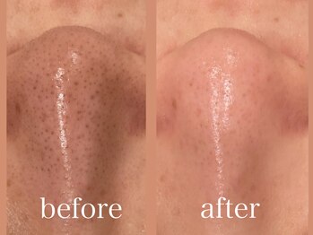 エピラックス(epilax)/ハイドラフェイシャル