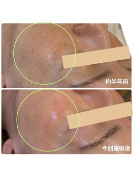 チョチョワンプラス(緒々one+)/約半年の変化