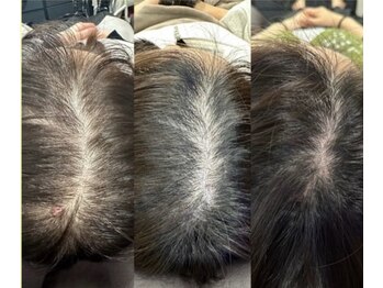 アンノン(Annon)/臍帯羊膜幹細胞の頭皮導入症例