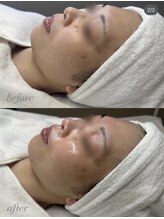 サロンドシェフィア(Salon de Chefia)/30代後半女性 症例写真