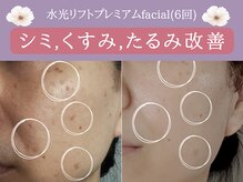 ミトラ(MITRA)/水光リフトfacialでリフトUP美肌
