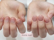 ミンスネイル(Mins Nail)/深爪長さ出しbefore&after