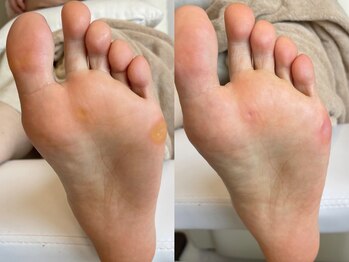 キラネイル アンド アイラッシュ by World Beauty(KIRA)/#新潟巻爪 #ペディグラス