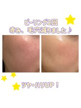 ビクト(Vict)/乾燥肌でもできる！！！