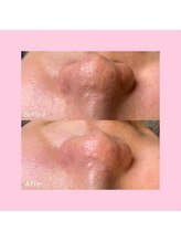 ホワイトラボ 天王寺(White labo)/【施術例】ハイドロフェイシャル