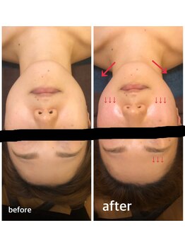 美フレッシュ 銀座店(美FRESH)/〈ハイパーナイフ施術10分効果〉