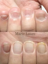 マリーロール 淀屋橋本店(Marie Laure)/自爪育成/深爪矯正/ネイルケア