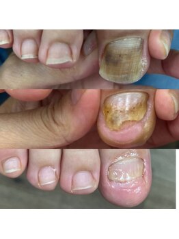 ウェルズユキ(well's yuki)/変形爪(爪が変)