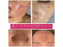 ビューティサロン アール(R)/お肌トラブルはさまざまです