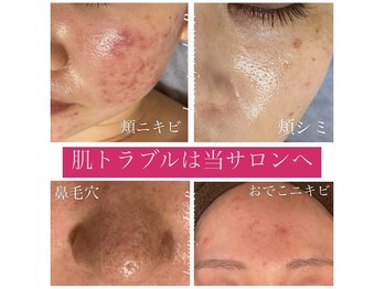 ビューティサロン アール(R)/お肌トラブルはさまざまです