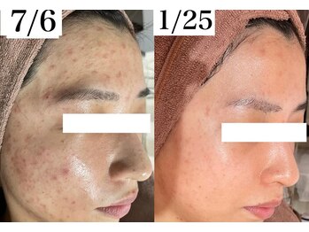 ホワイトアクア 福岡天神店(WHITE AQUA)/ハーブピーリングで肌改善!