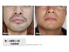 【OPEN記念】メンズ◇ひげ脱毛1回￥6,000→￥4,000