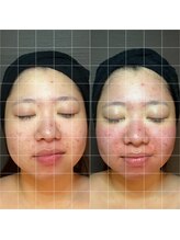 エラ(ella)/２０代　小顔矯正コルギ