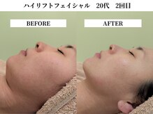 サンビ(SANBI)/フェイスラインすっきり小顔に！