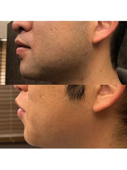 フェリーバ 流山店(FELIVA)/剃りずらいフ頬などもも綺麗に♪