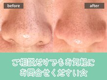 キザシ(kizashi)/最新毛穴ケア☆即実感！毛穴縮小