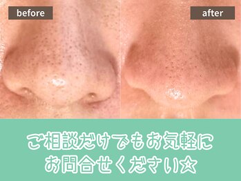 キザシ(kizashi)/最新毛穴ケア☆即実感！毛穴縮小