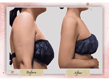 ヌーン(noon)の写真/サイズダウン目指す大人女子へ！ブライダルエステ痩身☆憧れのボディへ導きます♪