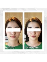 フローフシ∞/【小顔】30代女性症例写真