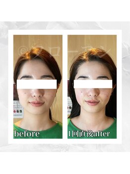フローフシ∞/【小顔】30代女性症例写真