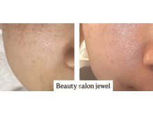 ジュエル(jewel)の雰囲気（通うたびに少しずつメラニンを排出し透明感のある素肌へ導きます）