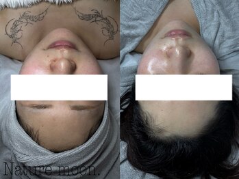 ナチュールムーン(Nature moon.)/毛穴洗浄・ハーブピーリング