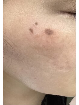 ヒカリ(Hikari)/施術直後