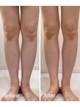 ミルタンドレス(Mille Tendresses)/半身筋膜リリース