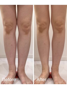 ミルタンドレス(Mille Tendresses)/半身筋膜リリース