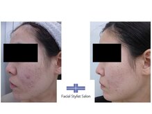 フェイシャルスタイリストサロン 高崎店(Facial Stylist Salon)/ケア例（87）
