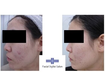 フェイシャルスタイリストサロン 高崎店(Facial Stylist Salon)/ケア例(87)