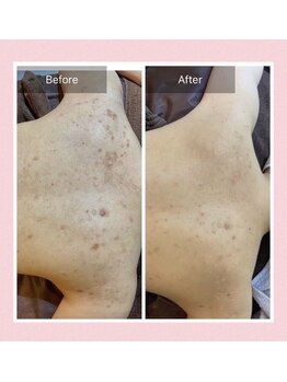 ファミリーセルフサロン 輪(Wa)/スーパーハードハーブピーリング