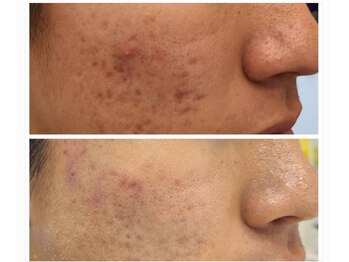 ビハダ(BeHADA)/シツコイニキビケア#アクネケア