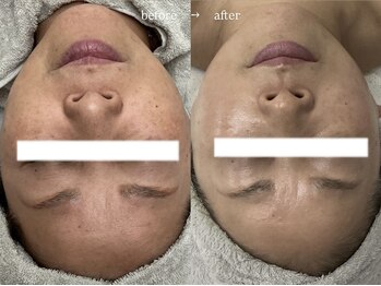 サロン レナ(Salon Re:na)/Reviハーブピーリング