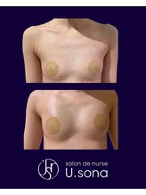 小顔・脂肪コントロール専門 salon de nurse U.sona～松本店～/【バストケア】脂肪増殖10cc