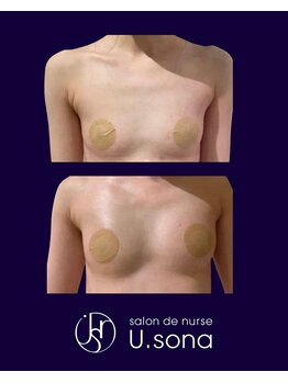 小顔・脂肪コントロール専門 salon de nurse U.sona～松本店～/【バストケア】脂肪増殖10cc