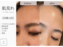 サロン ド パーフェクション(Salon de Perfection)/ハーブピーリング
