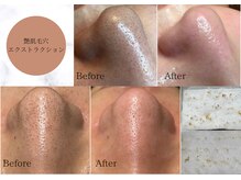 リモア(REMORE.)/毛穴エクストラクション認定店！