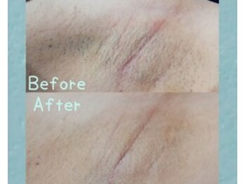 RiとBiのたまご/（脱毛）　ワキ