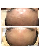 トータルビューティサロン リボーテ(Re:Beaute)/気になる額のシワを改善