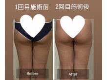 ウツク(utuku)/下半身BODYメイク　長岡/痩身